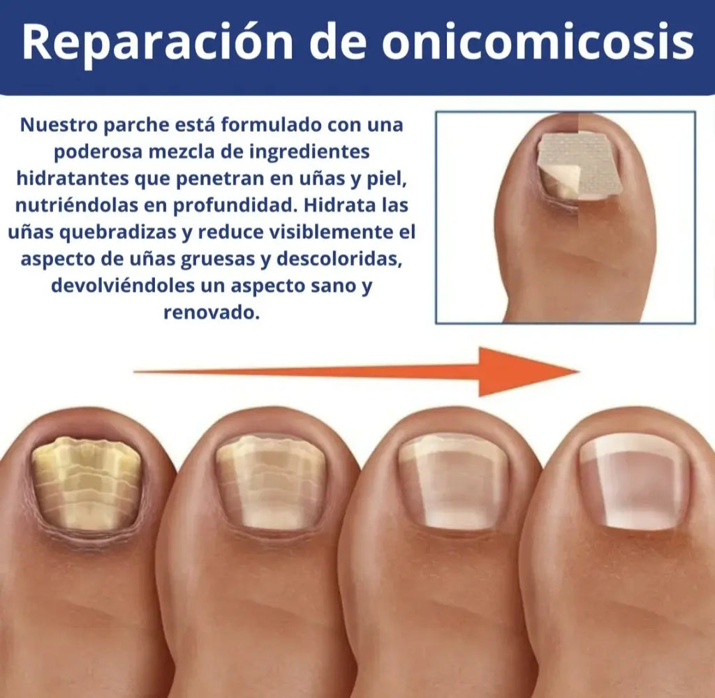 Parches AntiHongos 🩹 y Regeneradores De Uñas - FUNGAL NAIL PATCHES®💊
