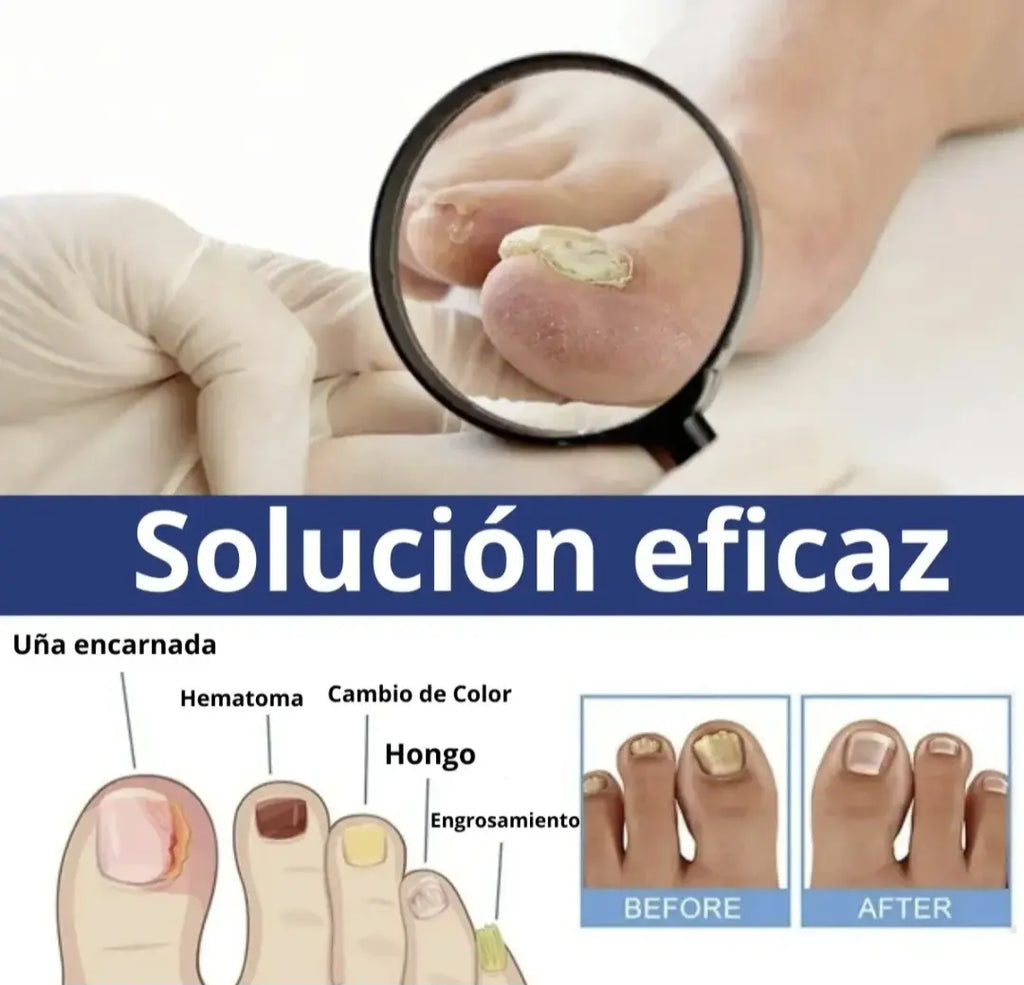 Parches AntiHongos 🩹 y Regeneradores De Uñas - FUNGAL NAIL PATCHES®💊